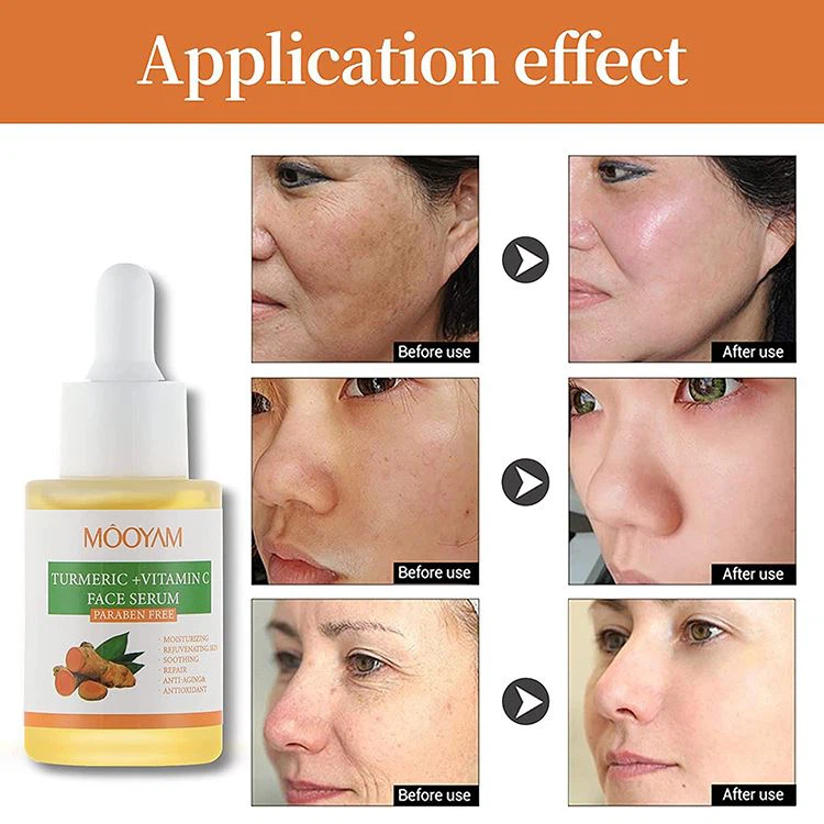 mooyam acne treatment turmeric serum