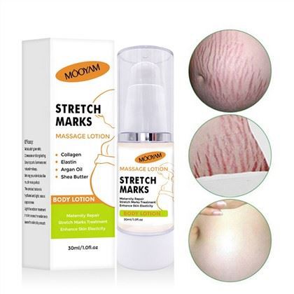 Effective Stretch Mark Removal Cream