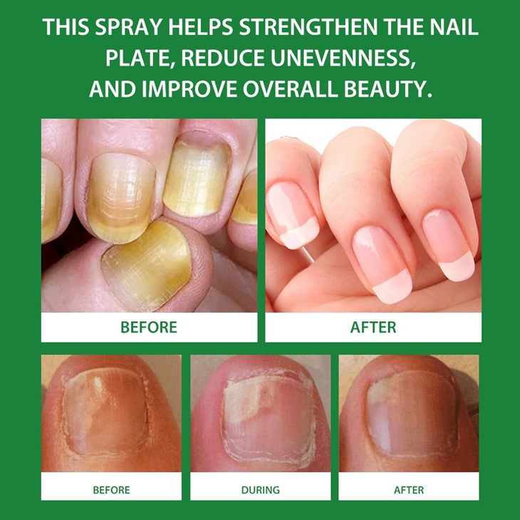 MOOYAM 7 Days Nail Fungus Treatment – Ginger Infused Nail Spray For Fast Relief