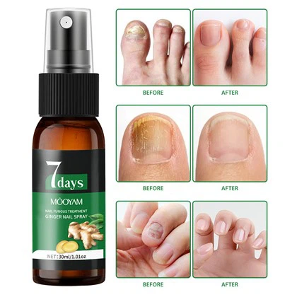 MOOYAM 7 Days Nail Fungus Treatment